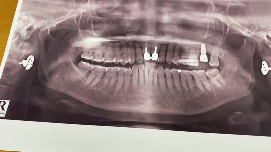 Lắp răng số 27 cho bác khách hàng tại Nha Khoa Thùy Anh cơ sở TP. Thái Nguyên.